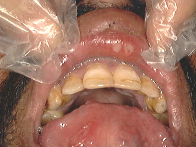 Aphthous stomatitis