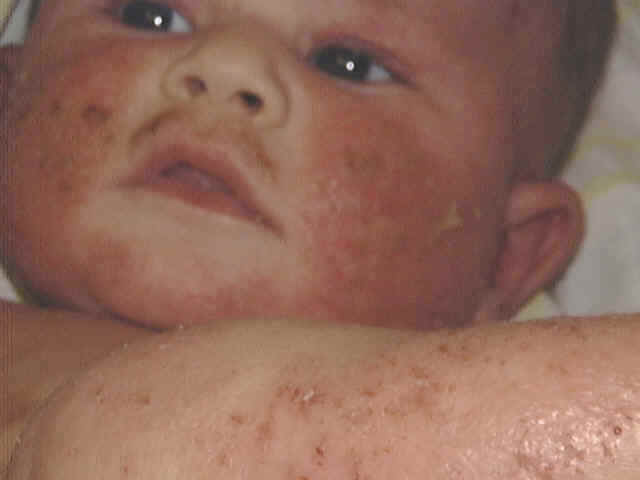 Eczema meaning
