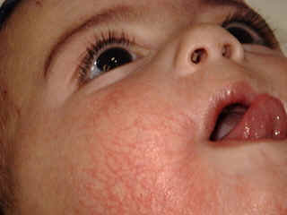 Corticosteroids side effects in toddlers