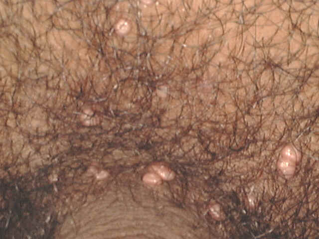 Vs penile herpes papules Difference between