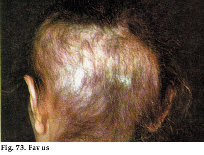Principles of Pediatric Dermatology - Chapter10 : FUNGAL SKIN INFECTIONS  SUPERFICIAL FUNGAL INFECTIONS TINEA CAPITIS