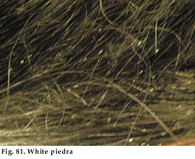 Principles Of Pediatric Dermatology Chapter10 Fungal Skin Infections Superficial Fungal Infections Tinea Capitis